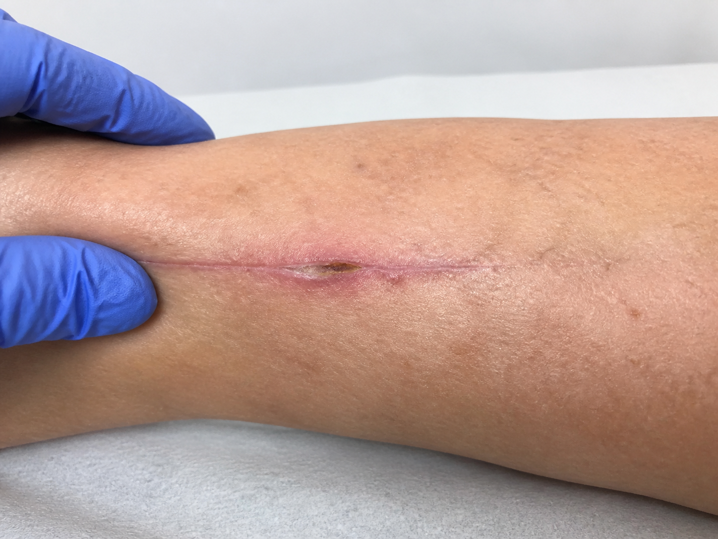 Clinical example of a post-surgical wound