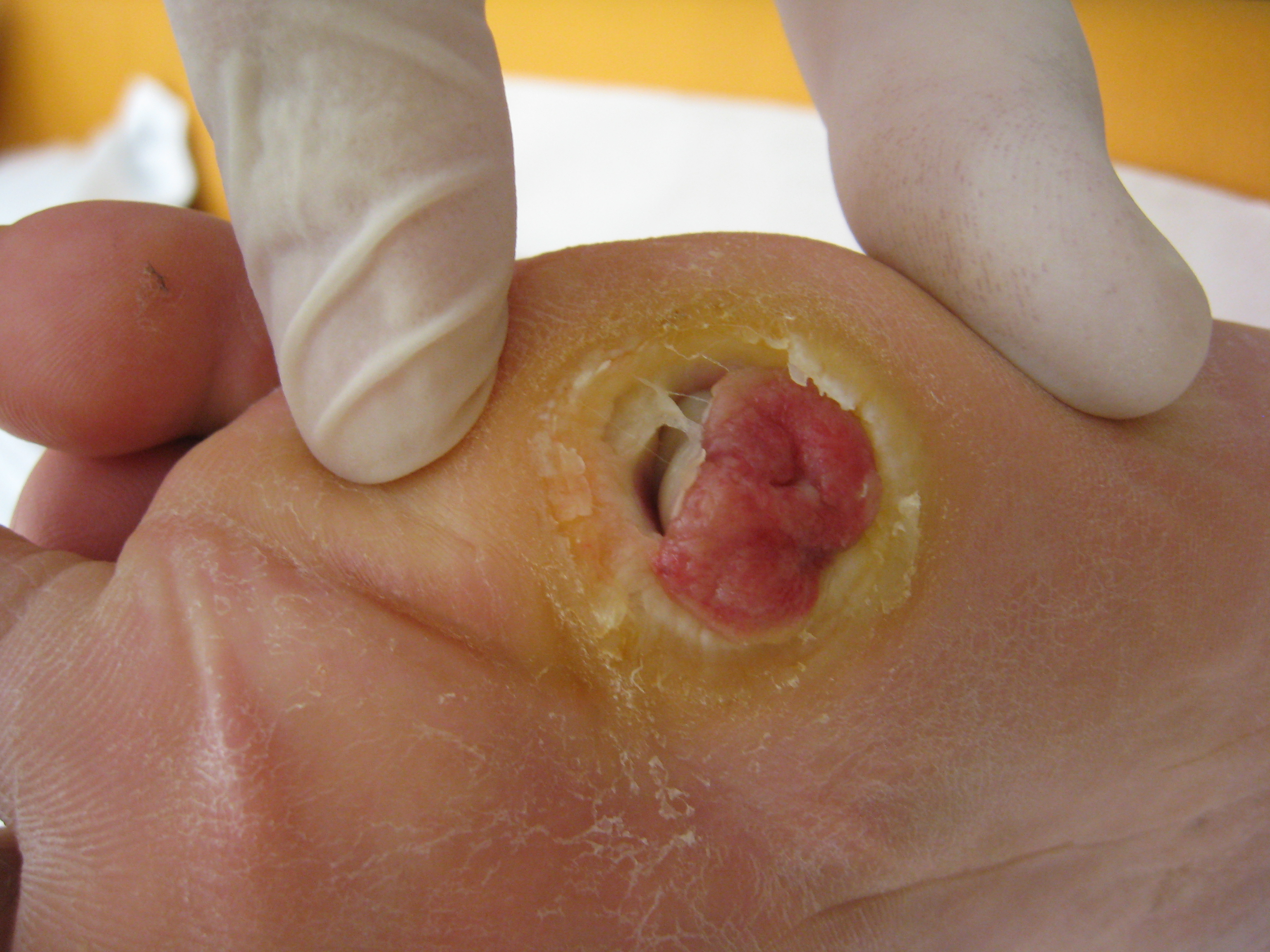 Real clinical photo of a diabetic foot ulcer