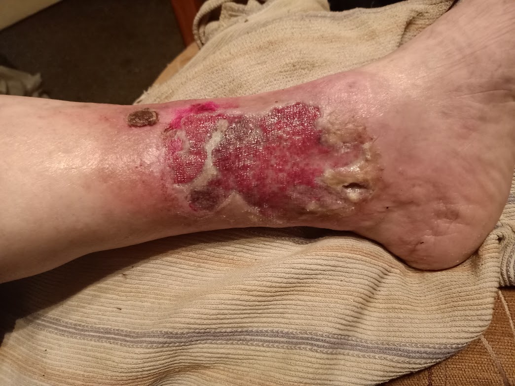 Real clinical photo of a venous leg ulcer